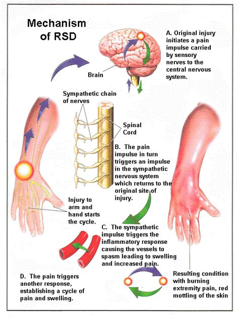 rsd medical abbreviation.